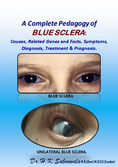 Blue Sclera Diagnosis illustration showing clinical signs